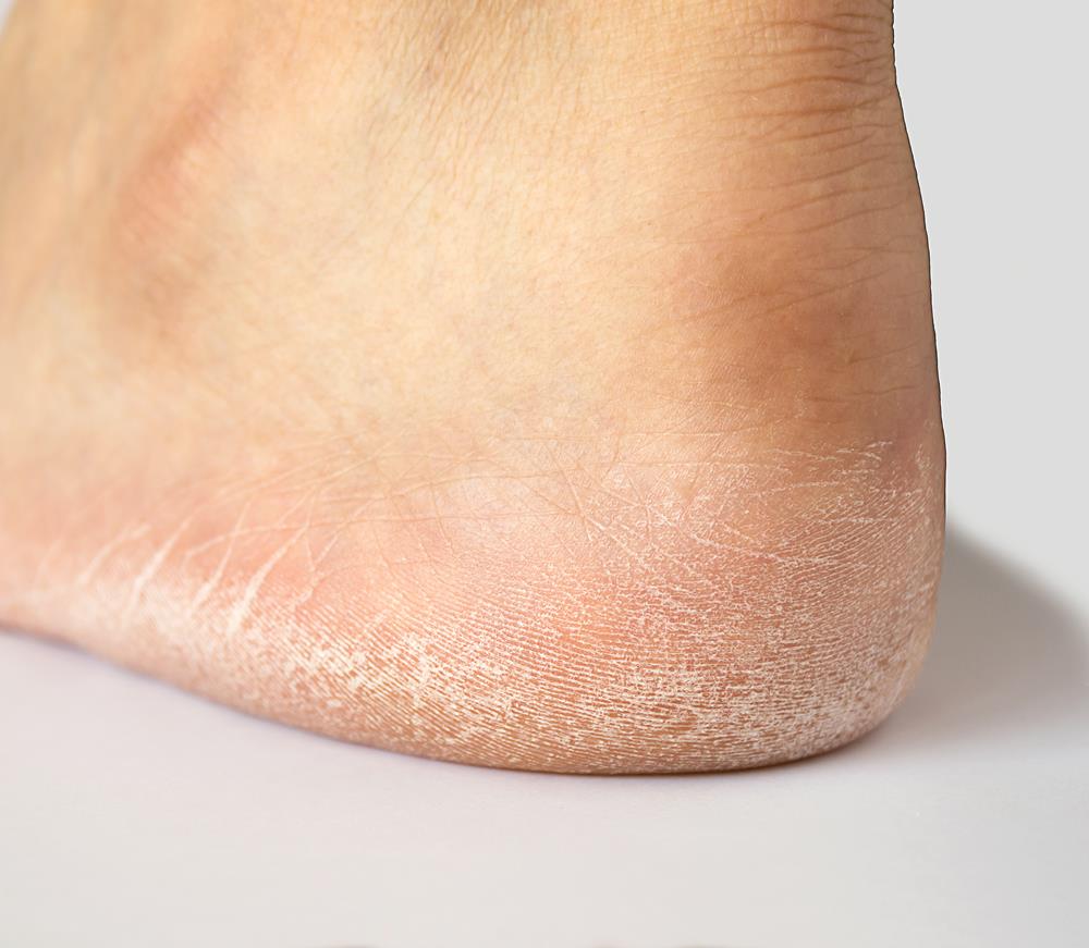 Diabetic Foot Care in Sarasota, FL Sarasota Foot and Ankle Center